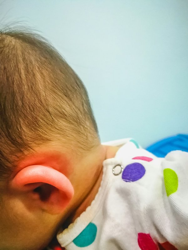 Eczéma oreille : conseils pratiques pour un soulagement rapide